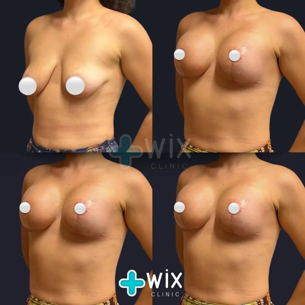 Breast Lift Before and After