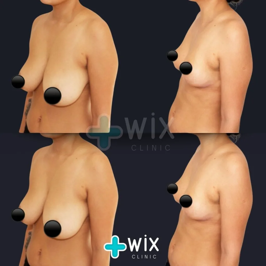 Breast Rediction Before and After