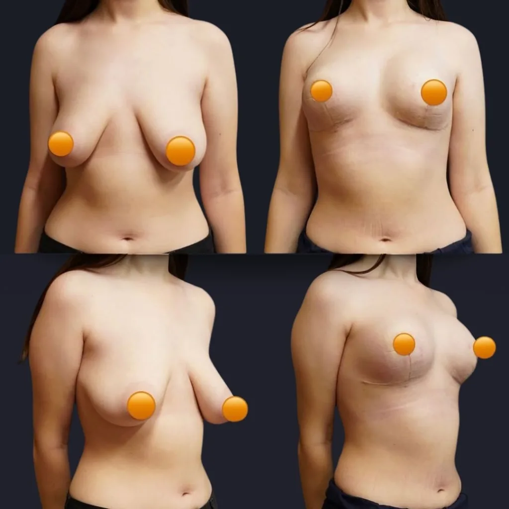 Breast Rediction Before and After