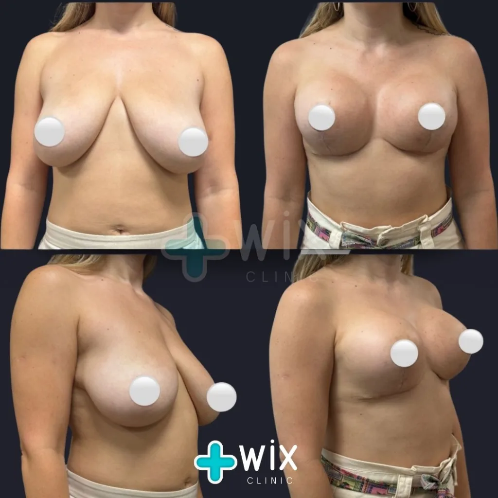 Breast Rediction Before and After