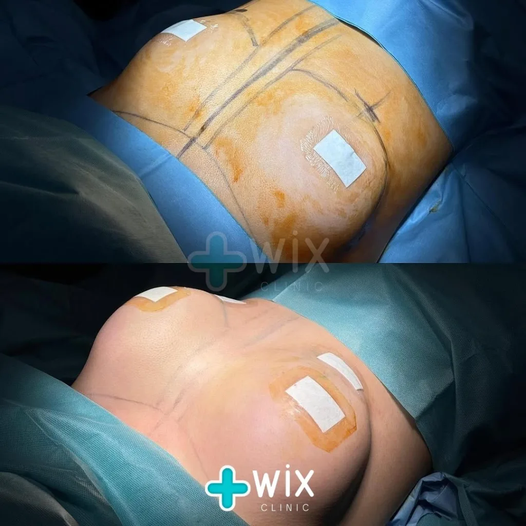 Breast Surgery Before and After