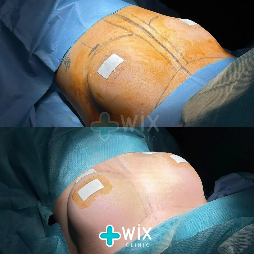 Breast Surgery Before and After