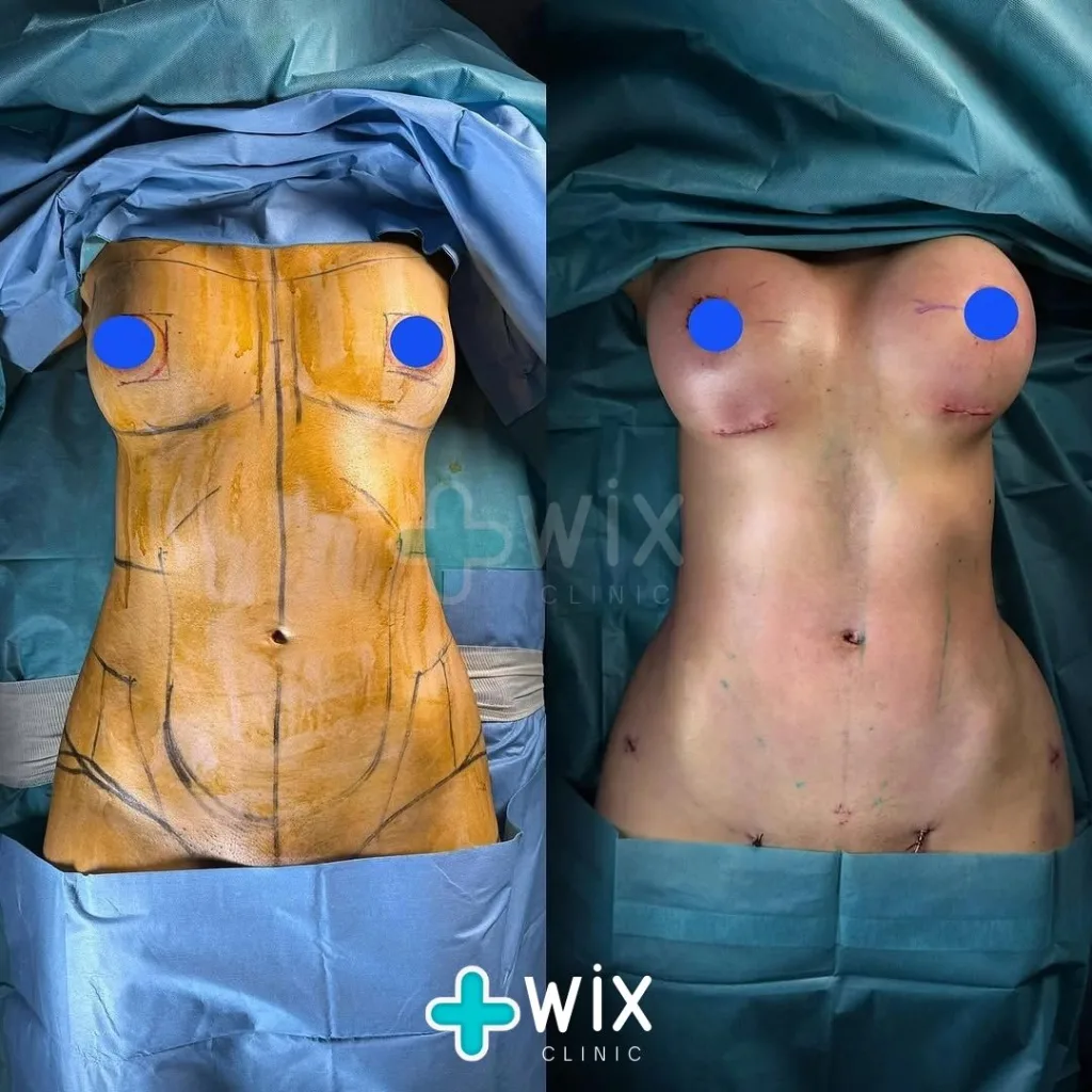 Breast Surgery Before and After