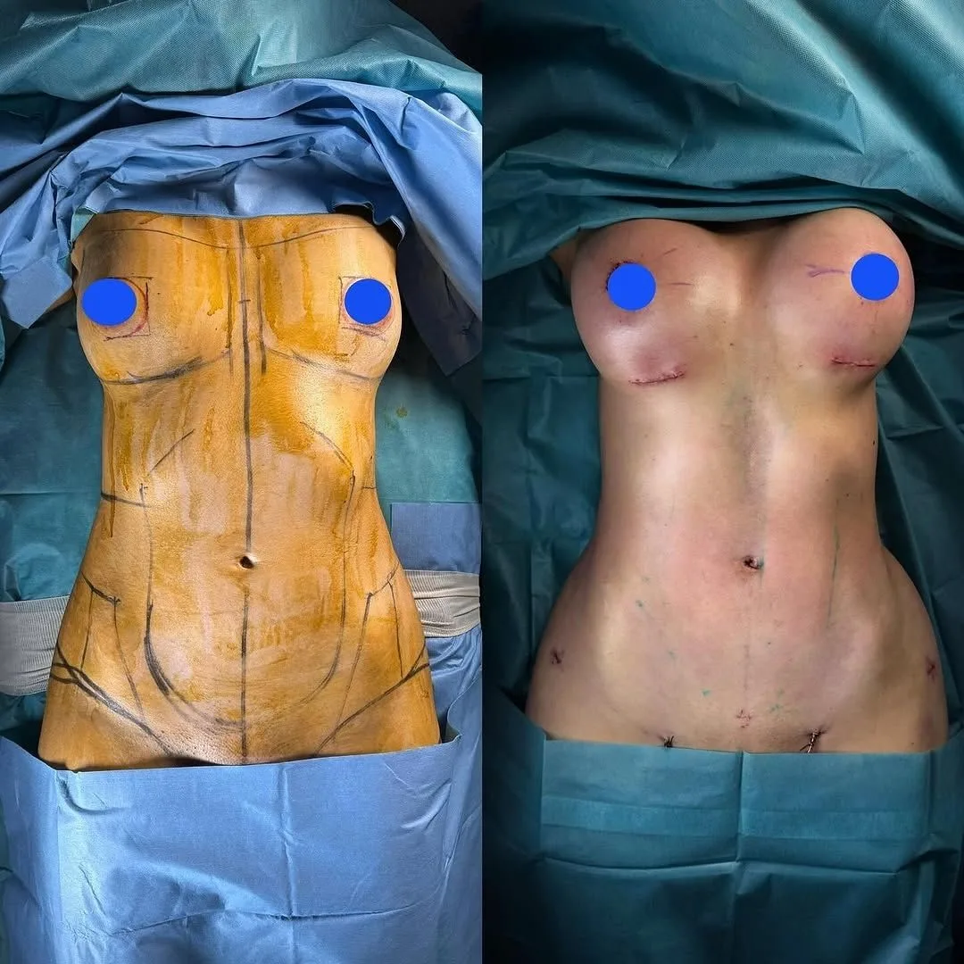 Breast Surgery Before and After