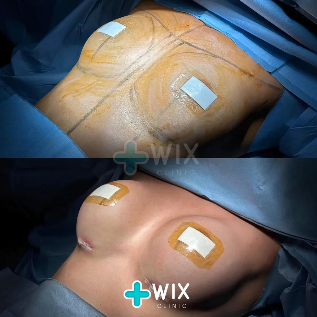 Breast Surgery Before and After