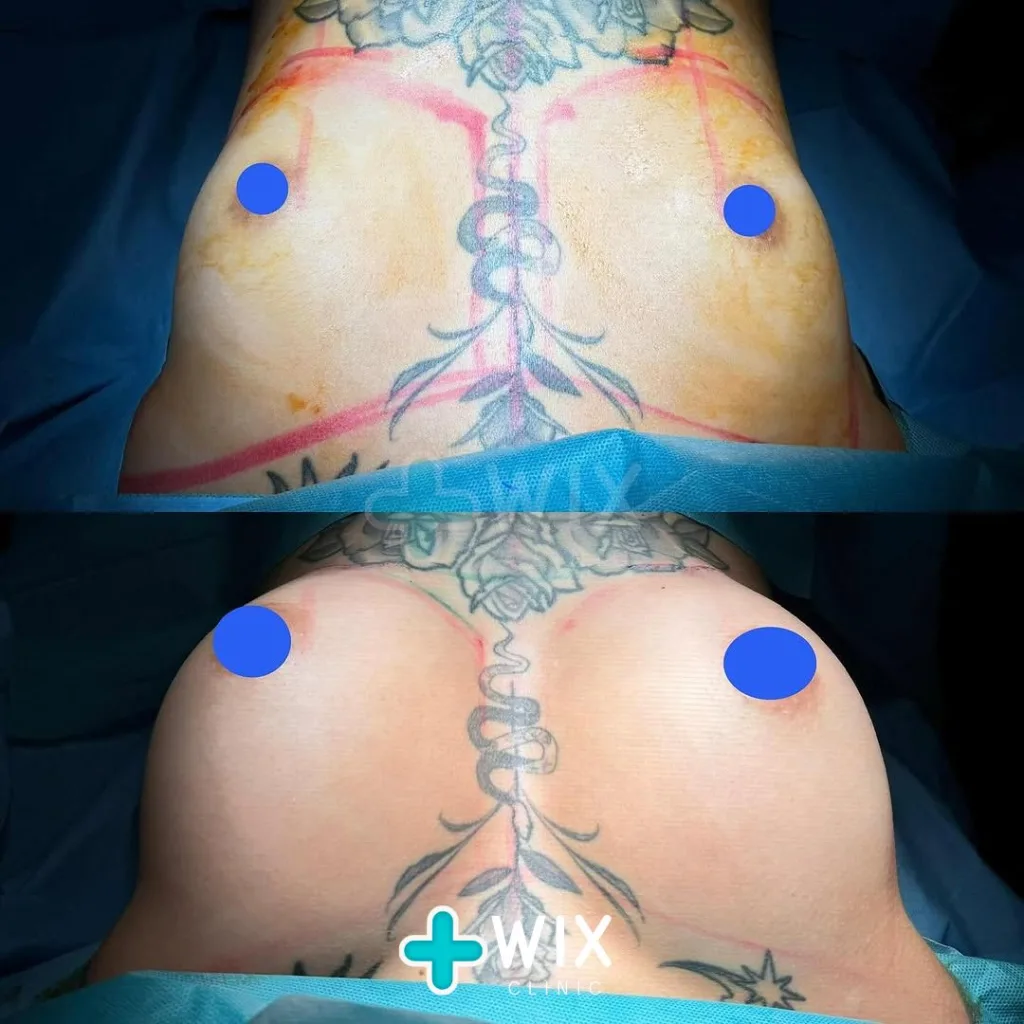 Breast Surgery Before and After