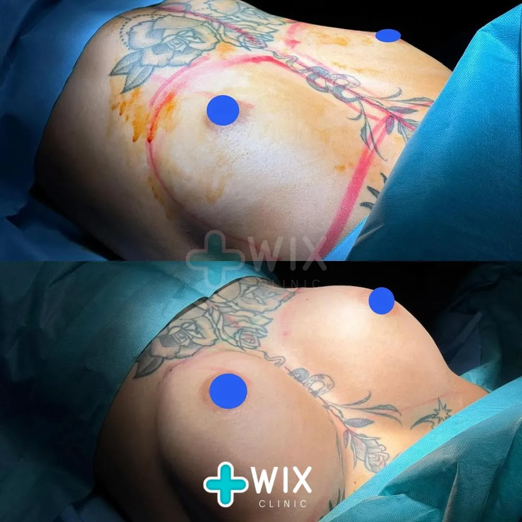 Breast Surgery Before and After