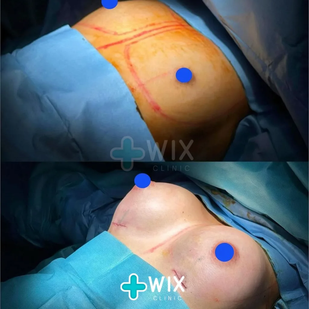 Breast Surgery Before and After