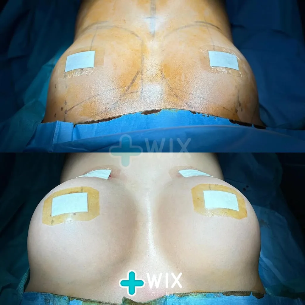 Breast Surgery Before and After