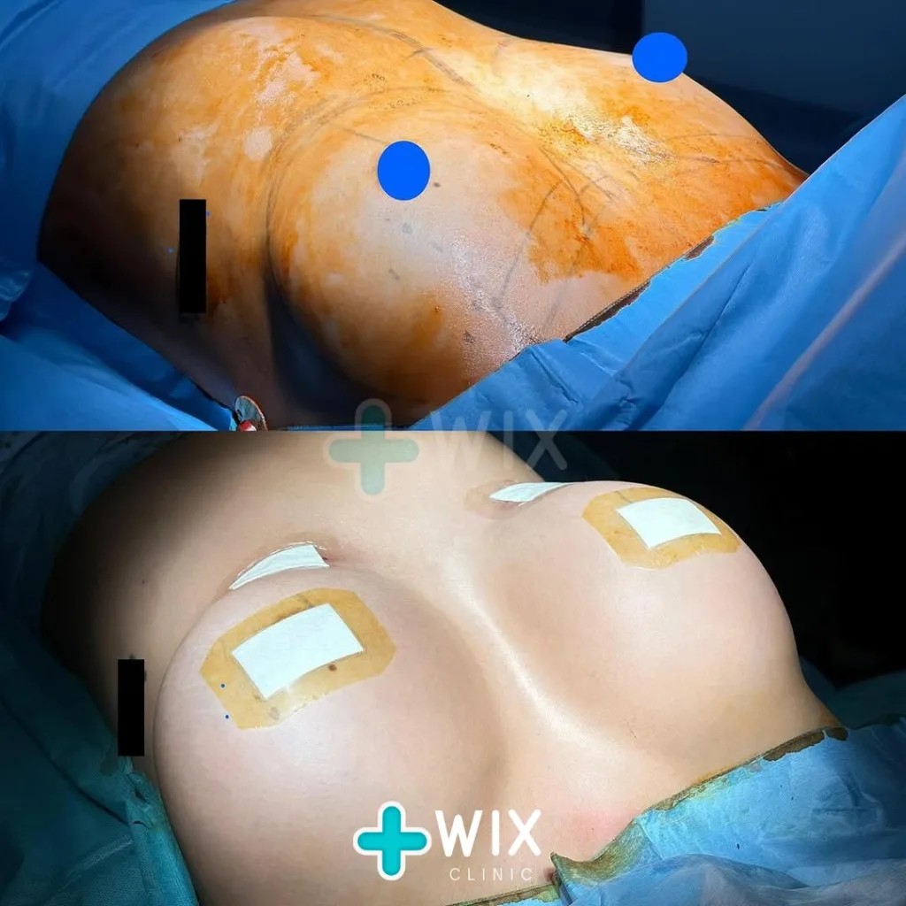 Breast Surgery Before and After