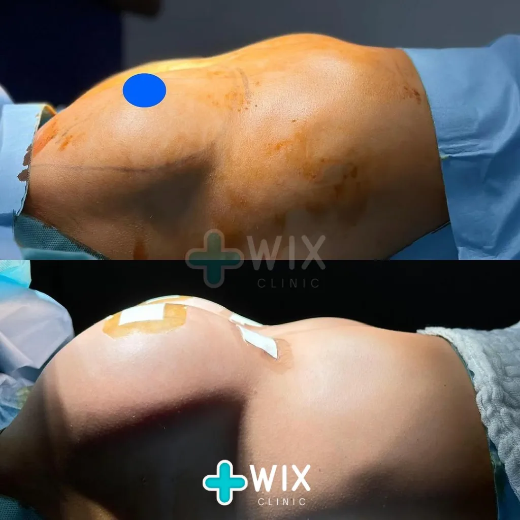 Breast Surgery Before and After