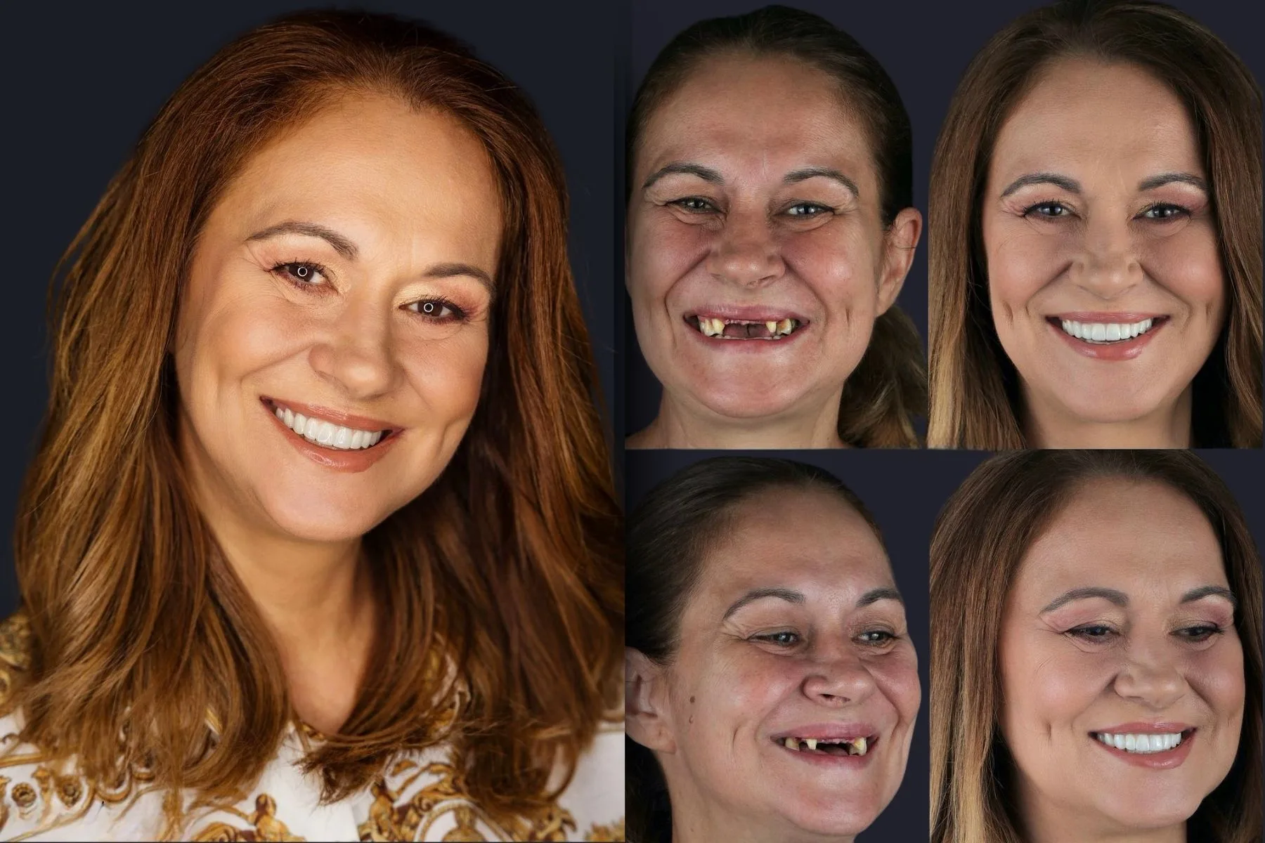 Dental Implants Before and After