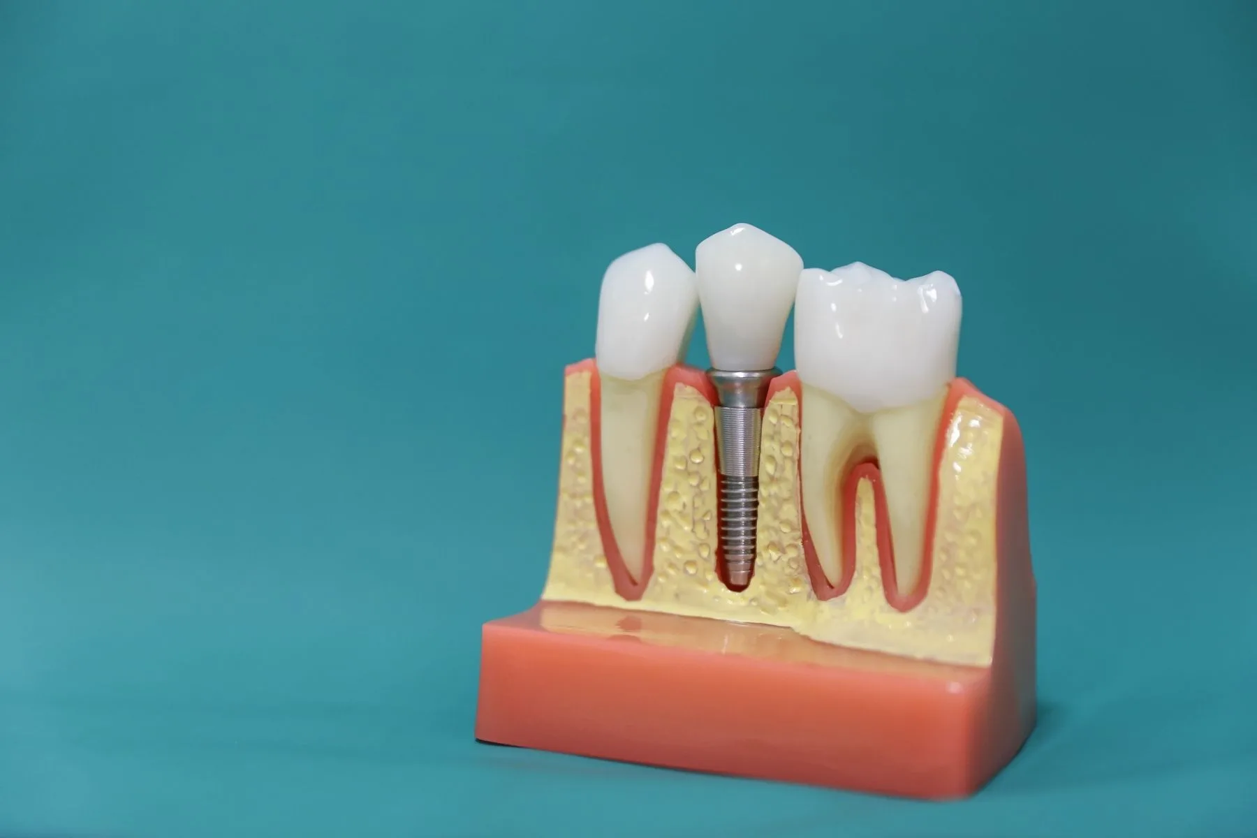 Dental Implants in Turkey