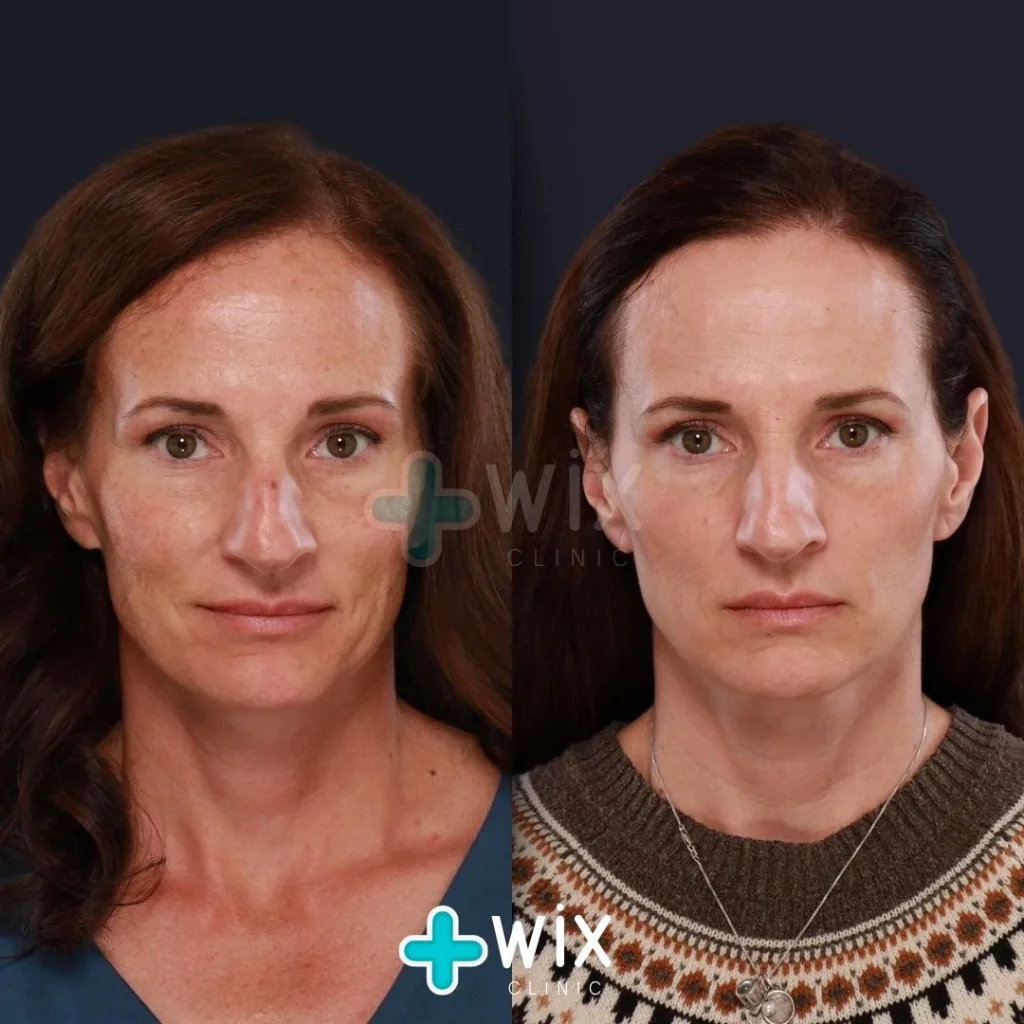 Face Laser Treatment Before and After