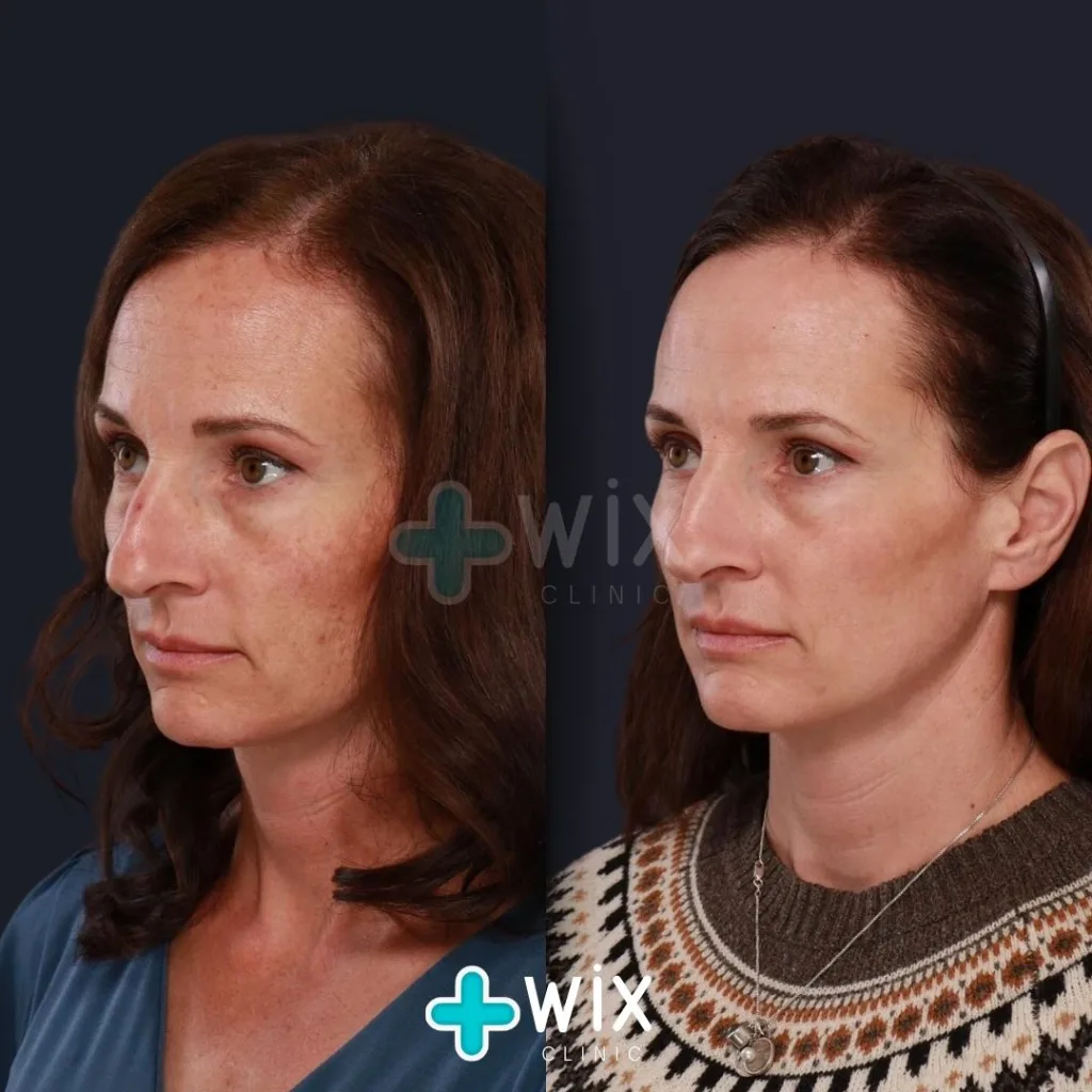 Face Laser Treatment Before and After