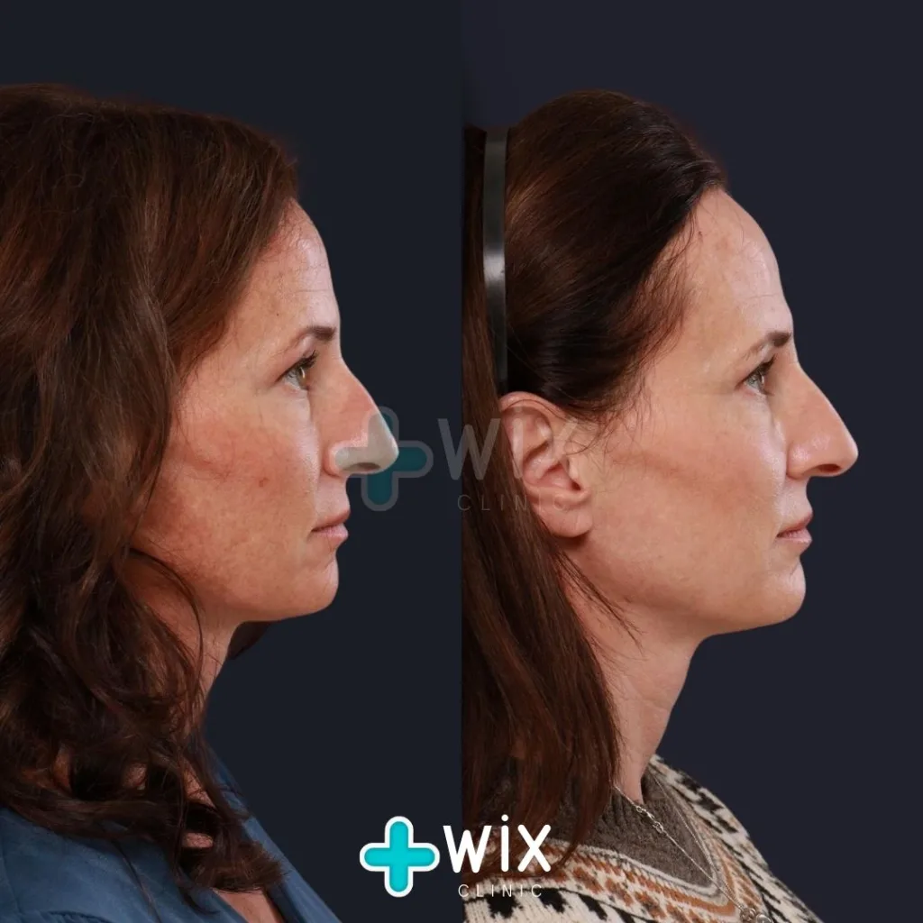 Face Laser Treatment Before and After