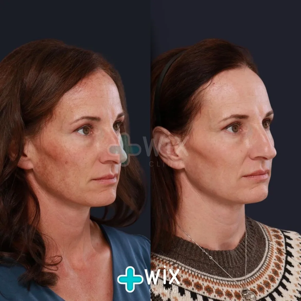 Face Laser Treatment Before and After