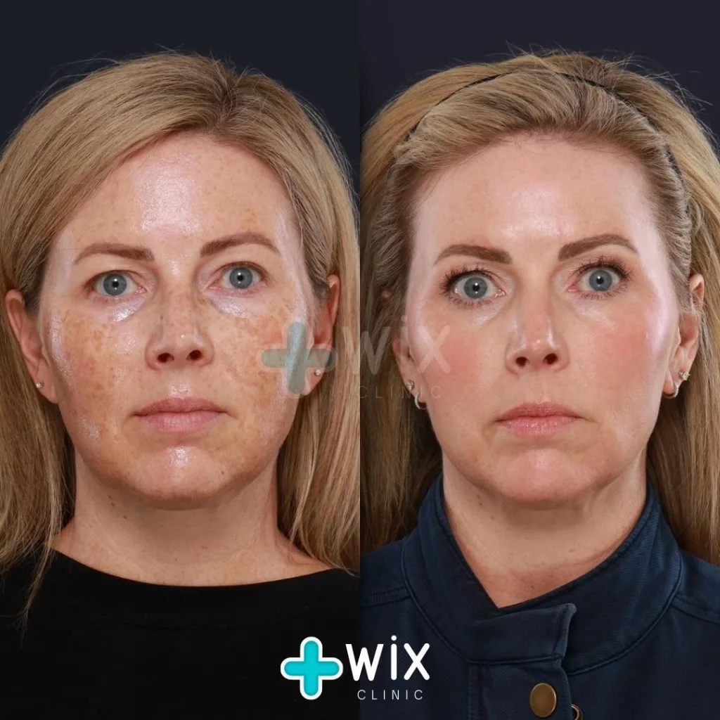 Face Laser Treatment Before and After