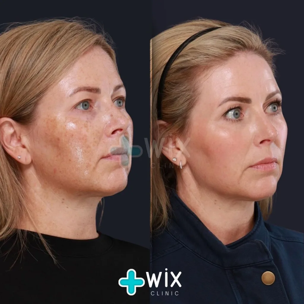 Face Laser Treatment Before and After