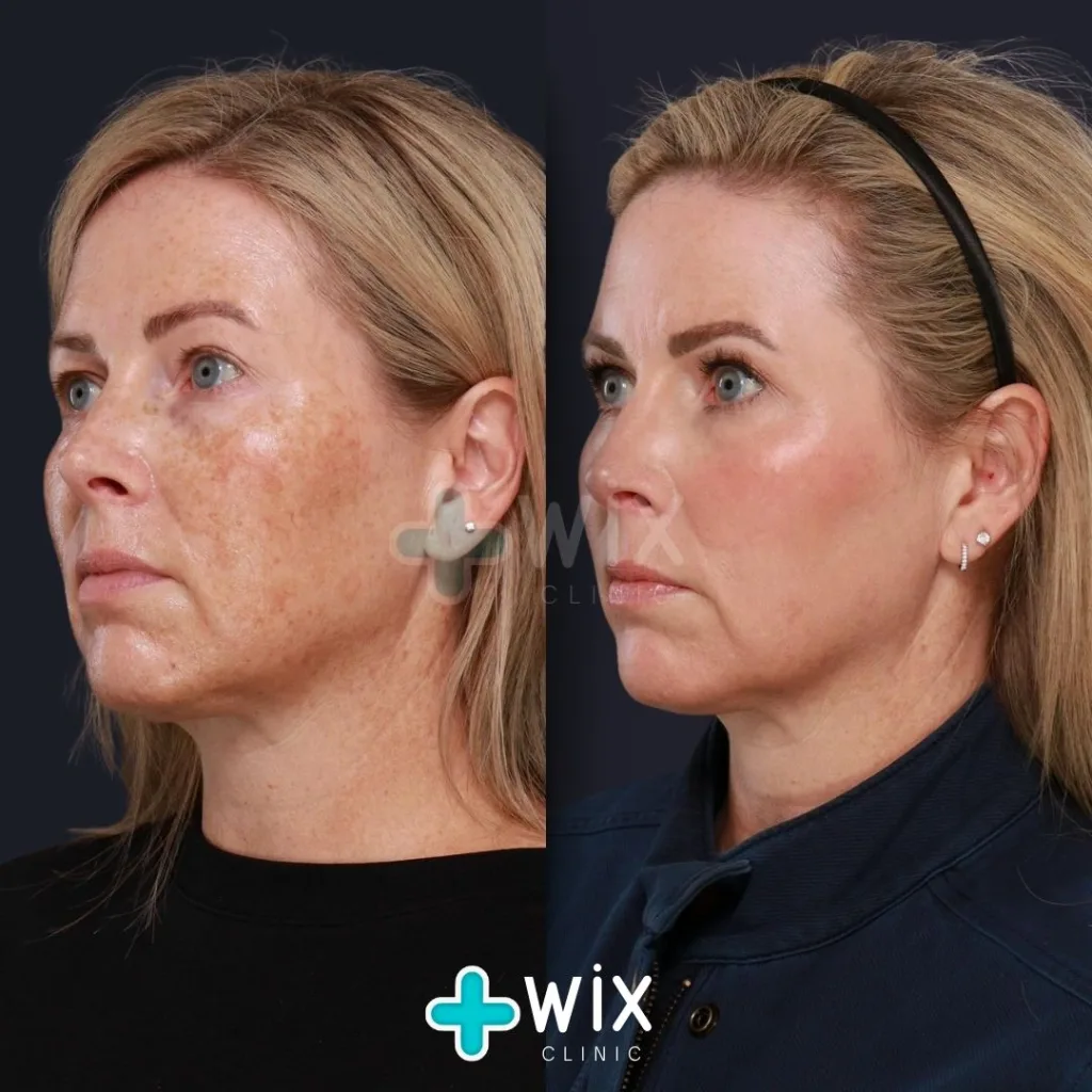 Face Laser Treatment Before and After