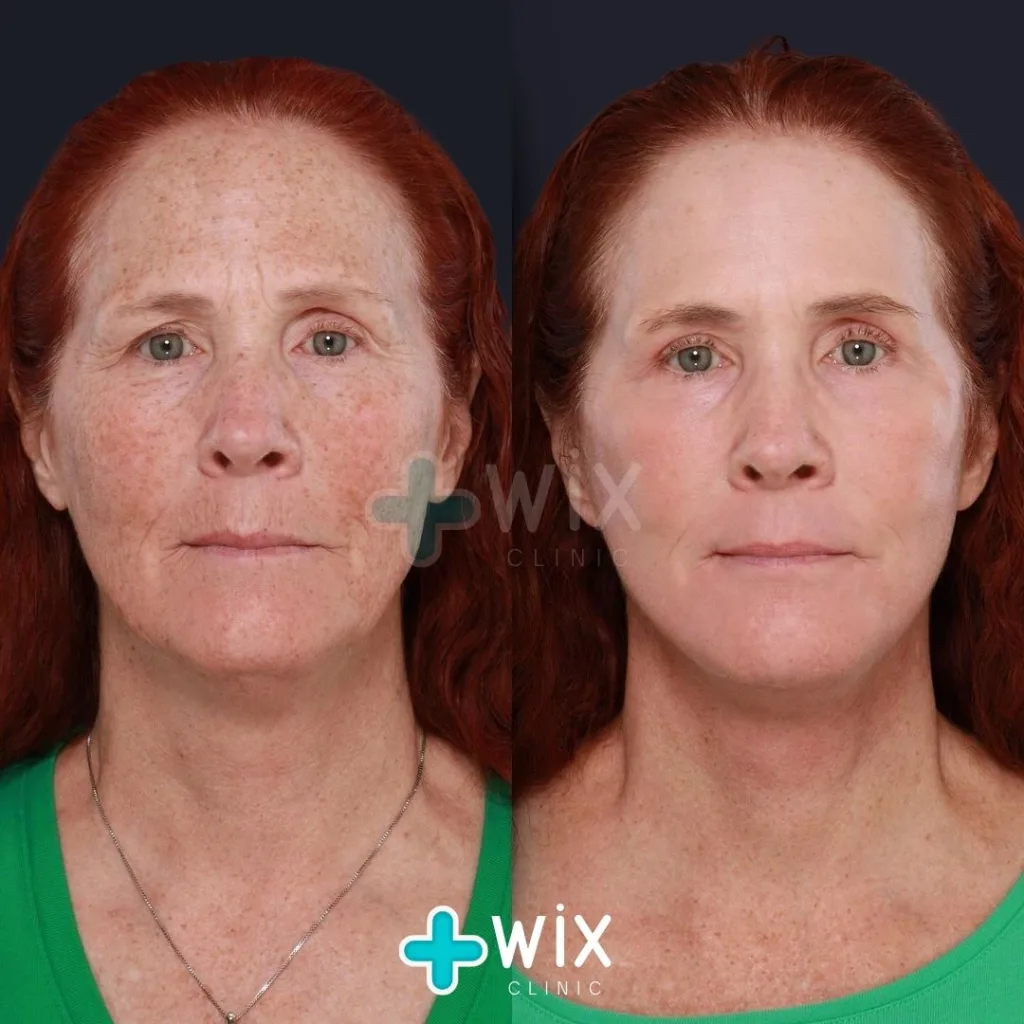 Face Laser Treatment Before and After