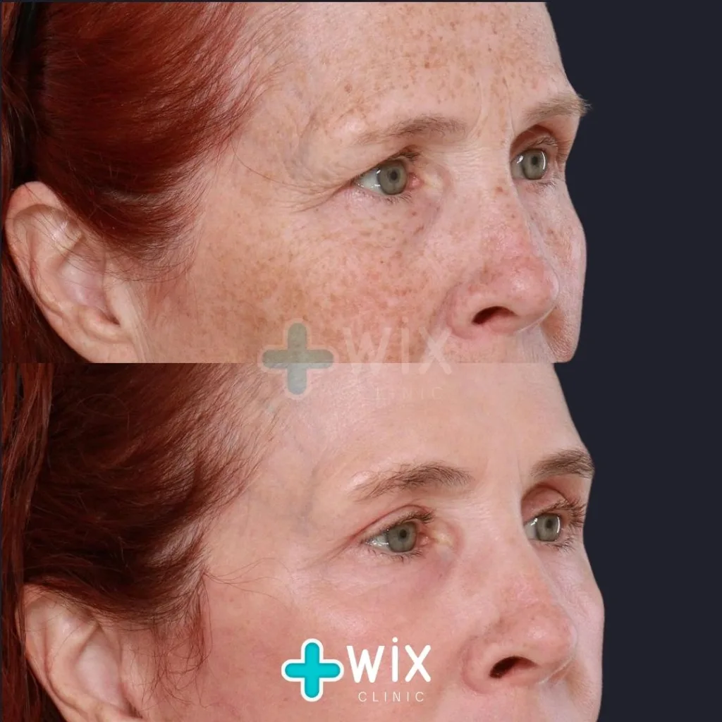 Face Laser Treatment Before and After