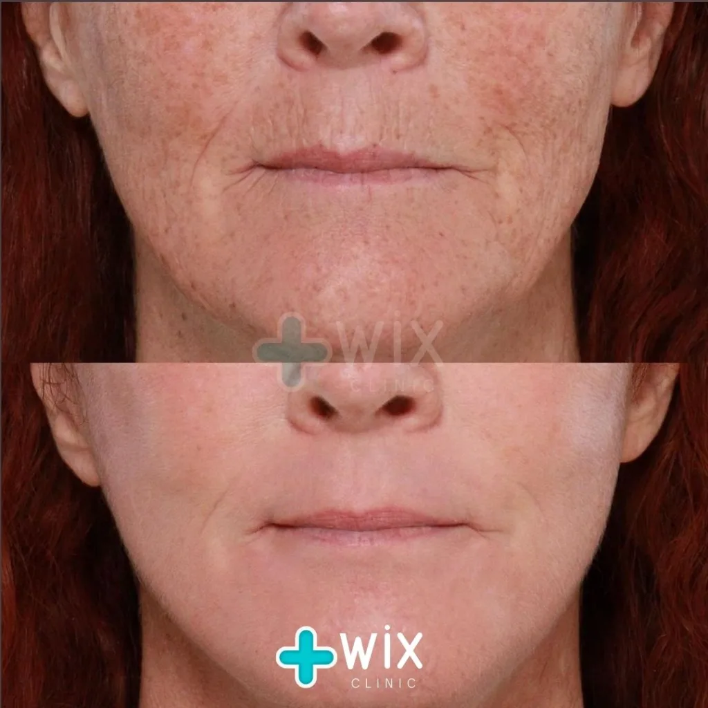 Face Laser Treatment Before and After