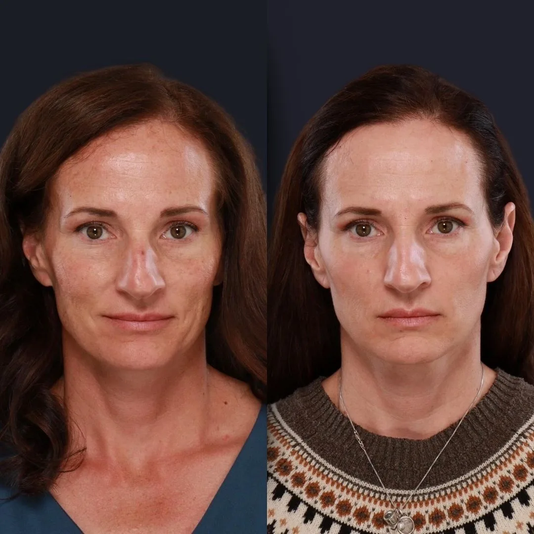 Face Laser Treatment - Before and After xx