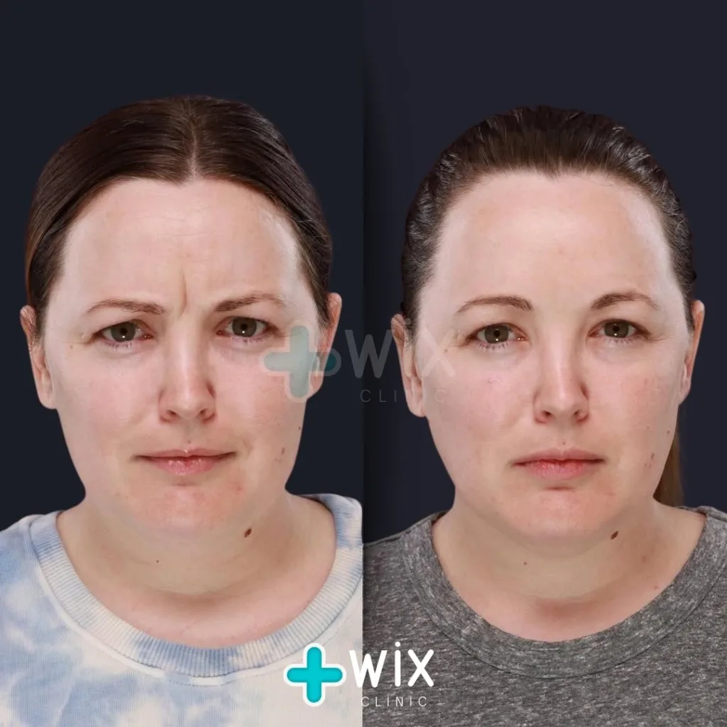 Face Medical Before and After