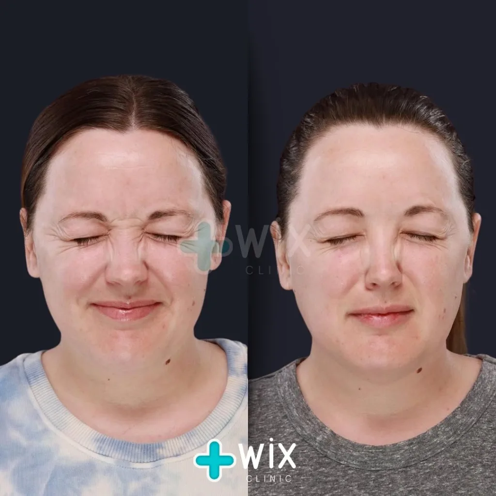 Face Medical Before and After