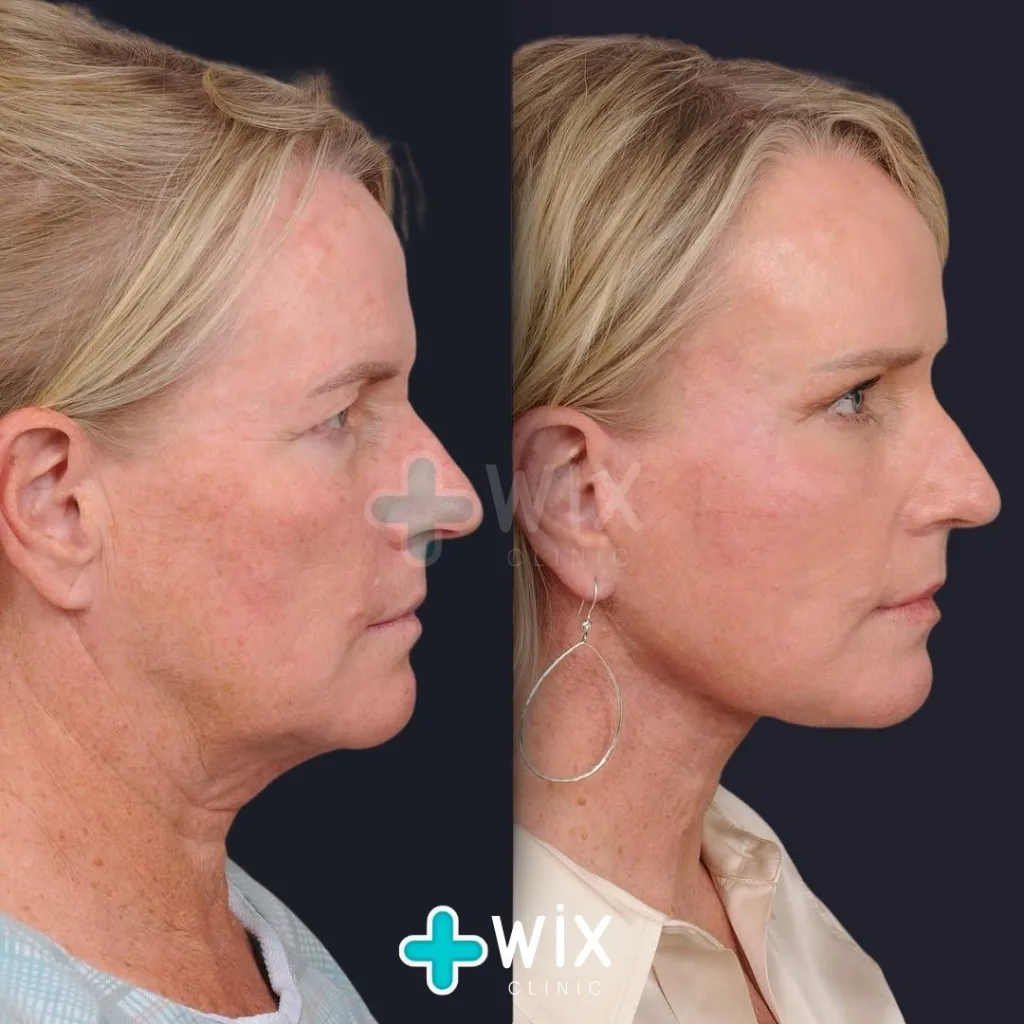 Facelift - Before and After