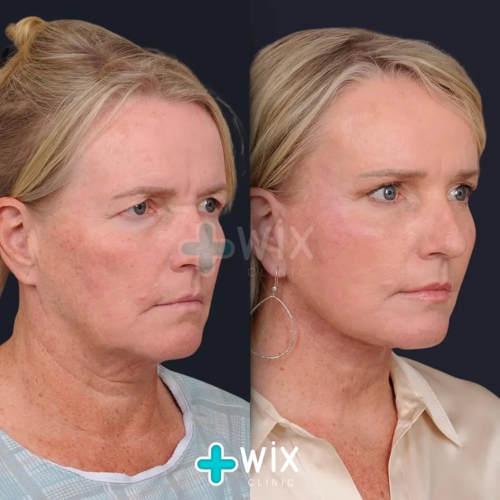 Facelift - Before and After