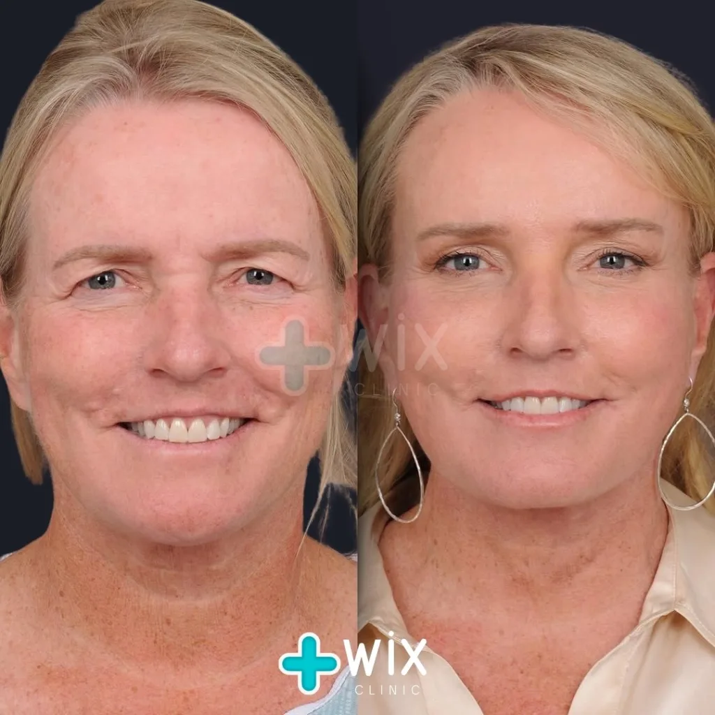 Facelift - Before and After