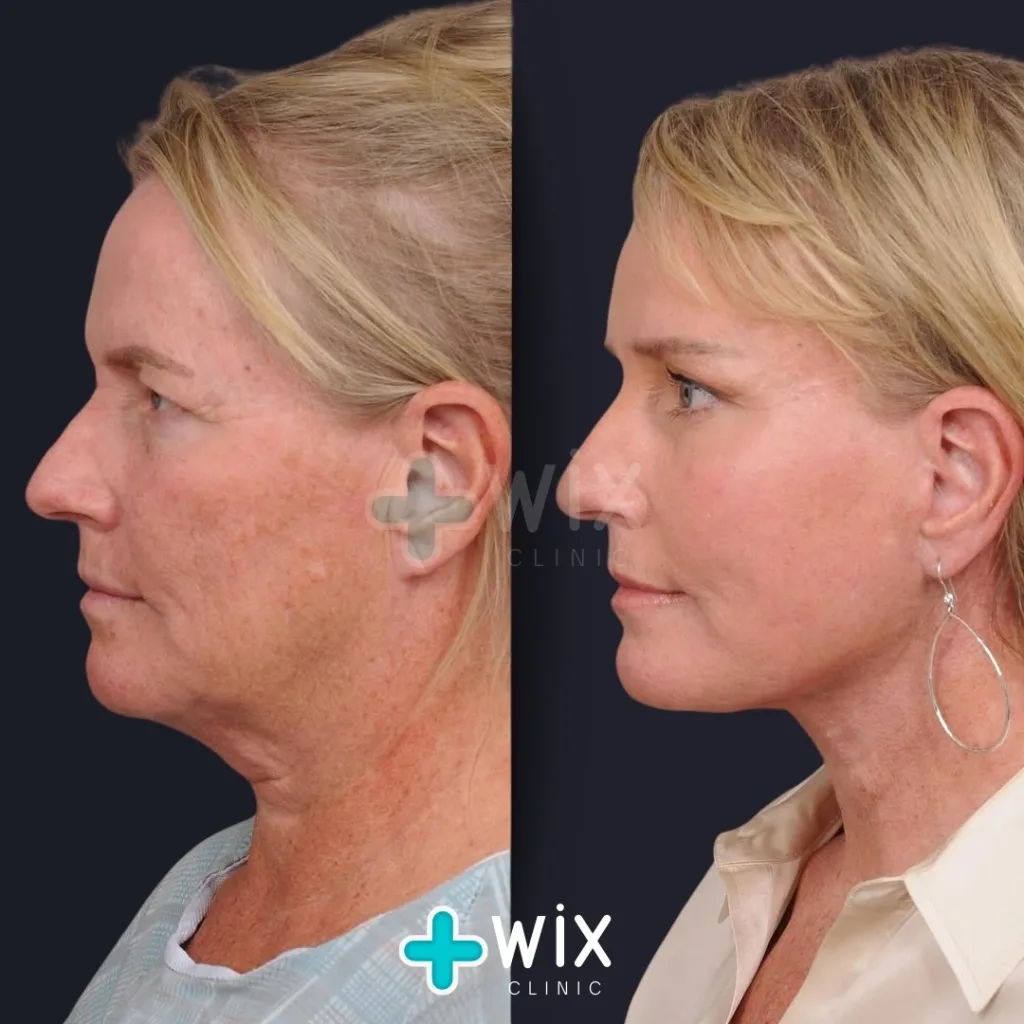 Facelift - Before and After