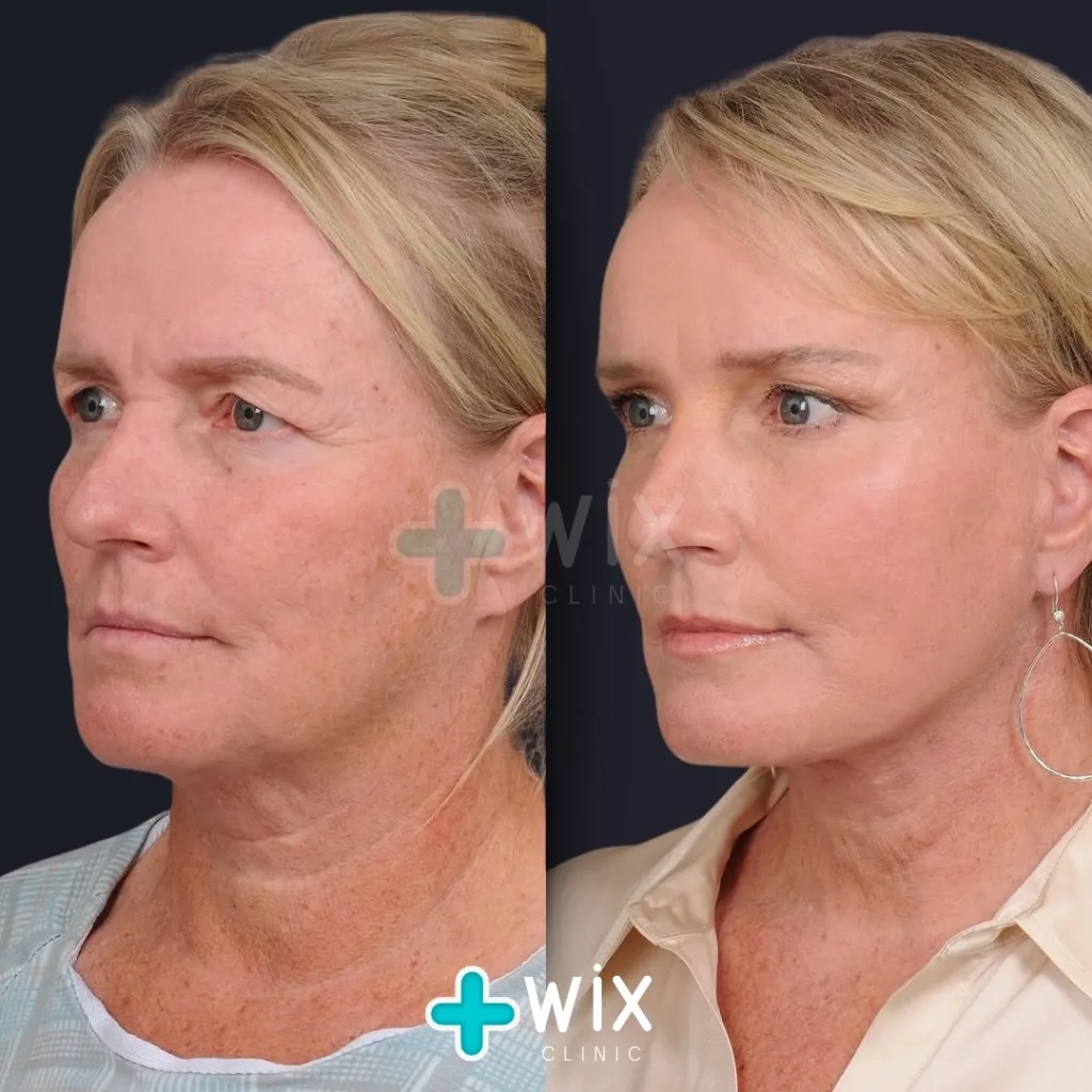 Facelift - Before and After