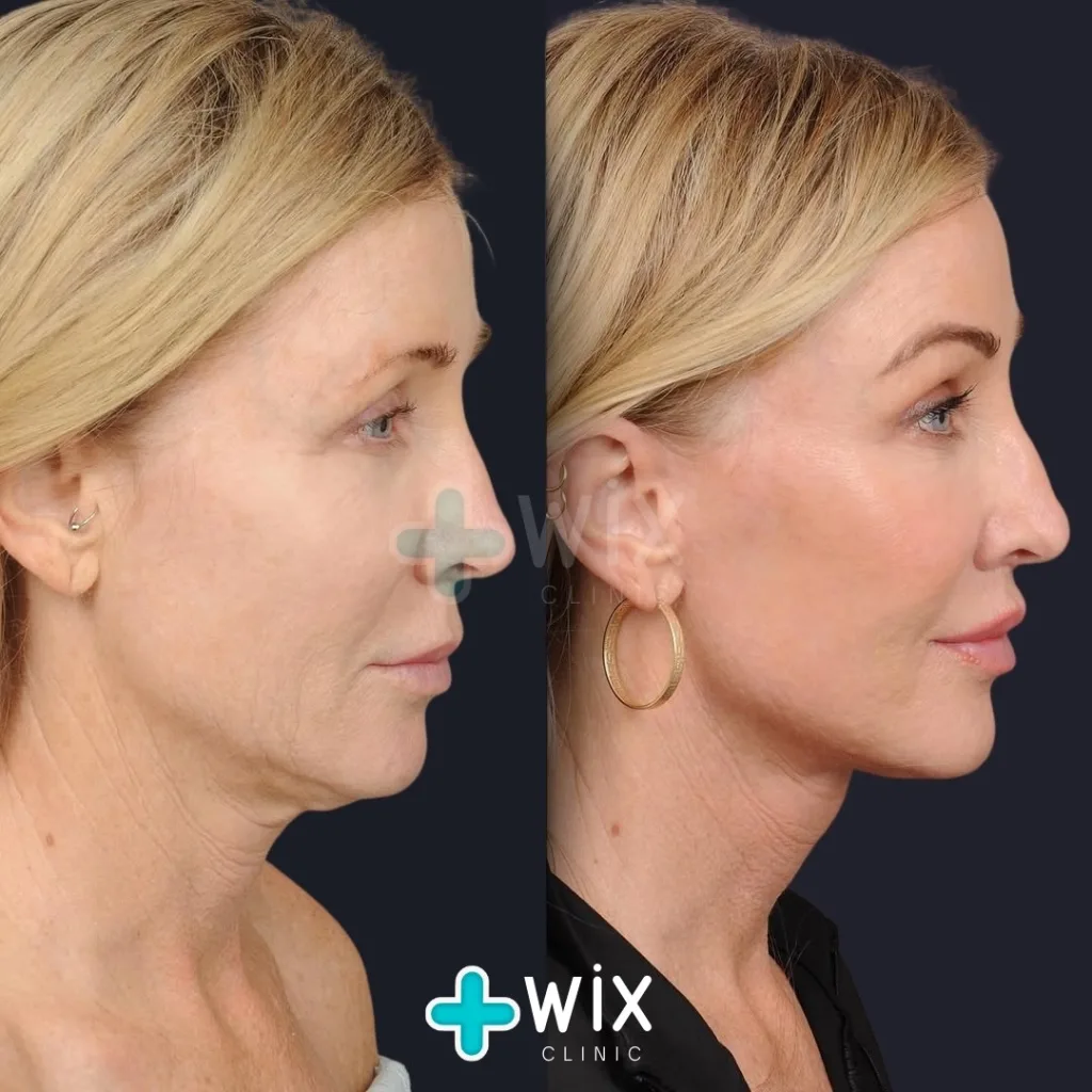 Facelift before and after