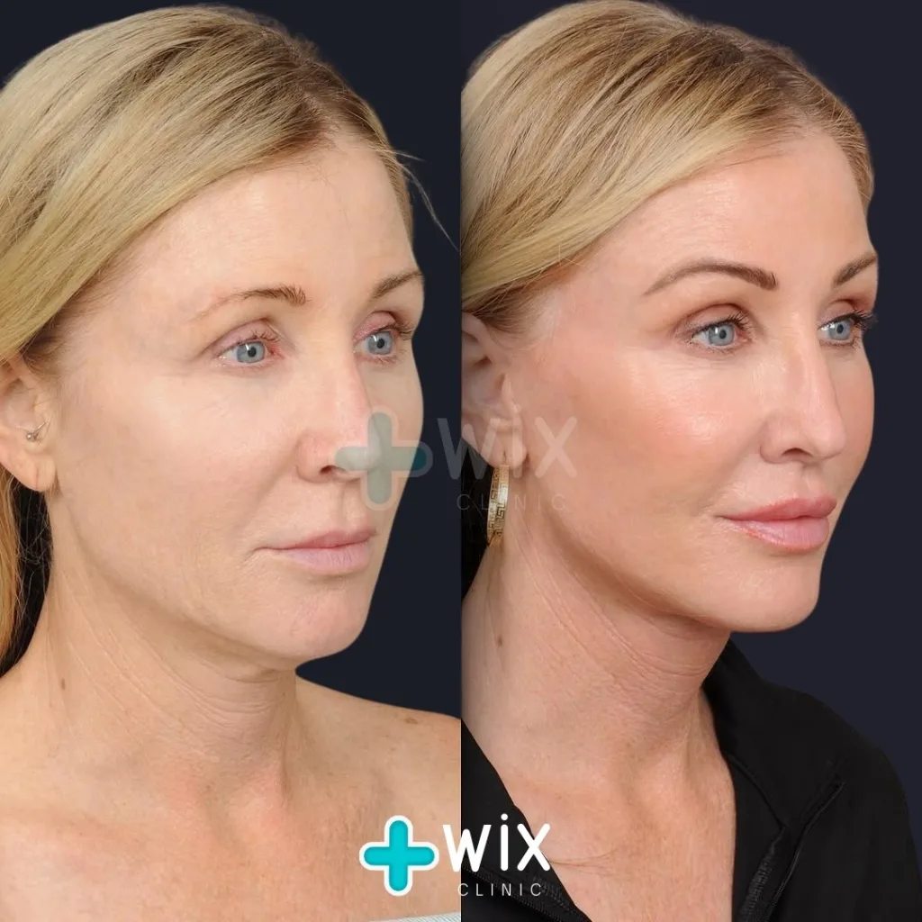 Facelift before and after