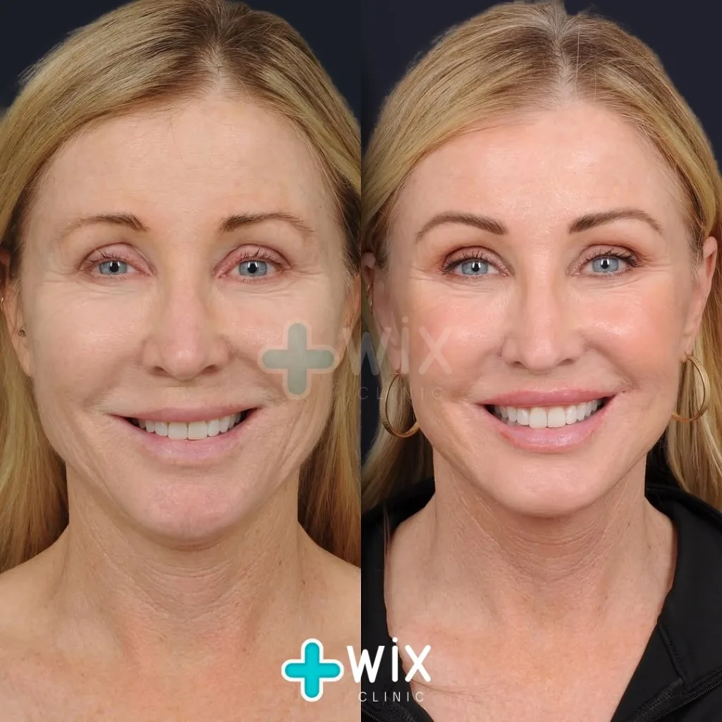 Facelift before and after