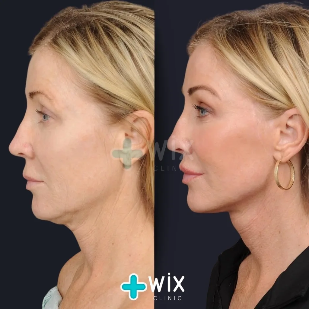 Facelift before and after