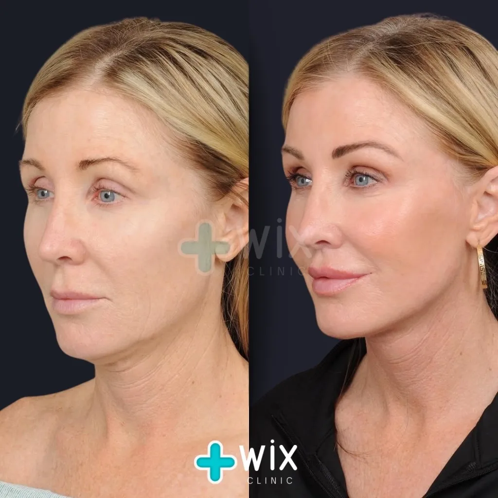 Facelift before and after