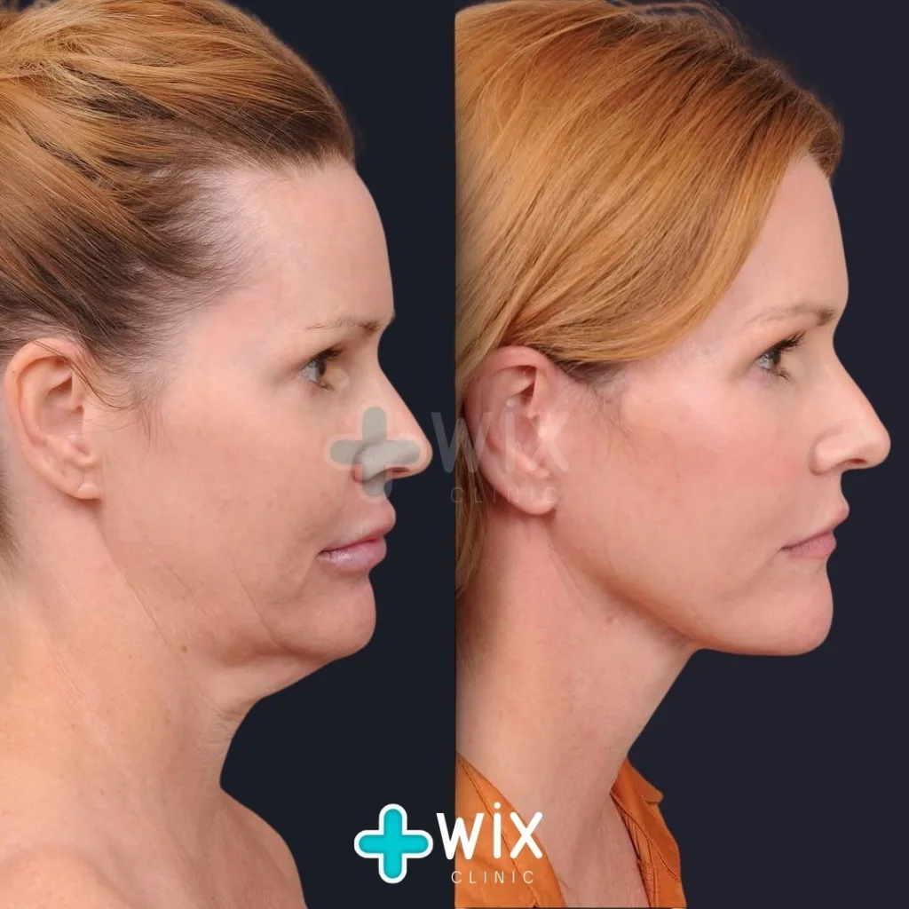 Facelift before and after