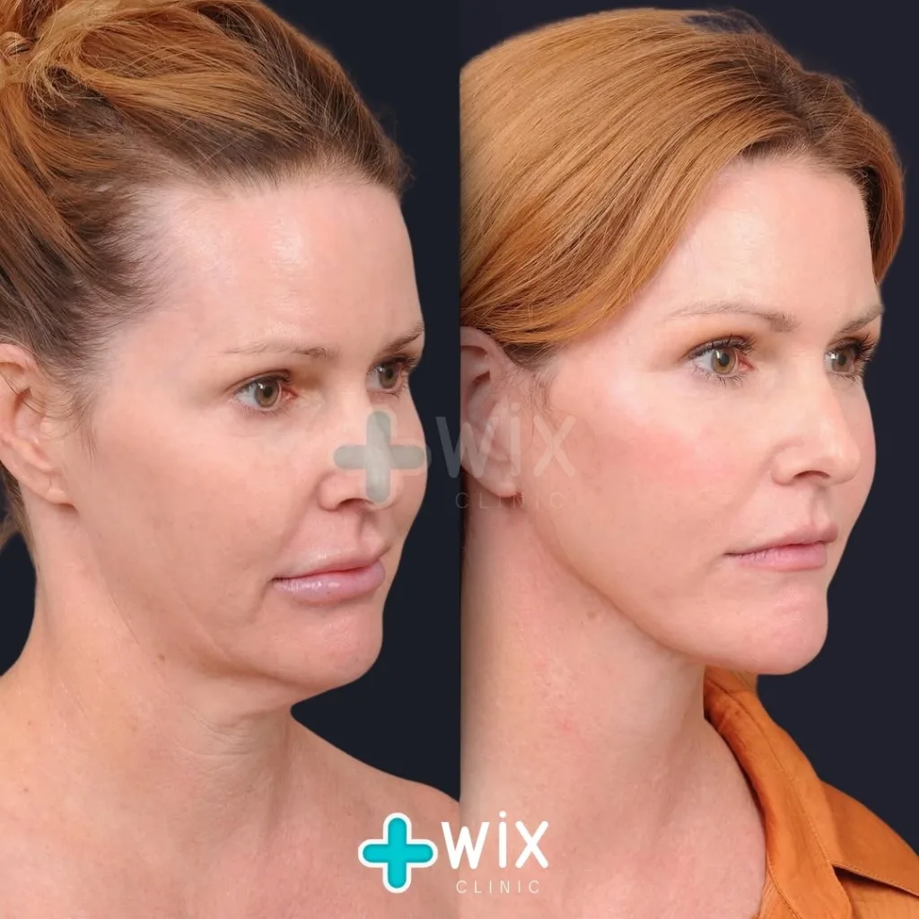 Facelift before and after