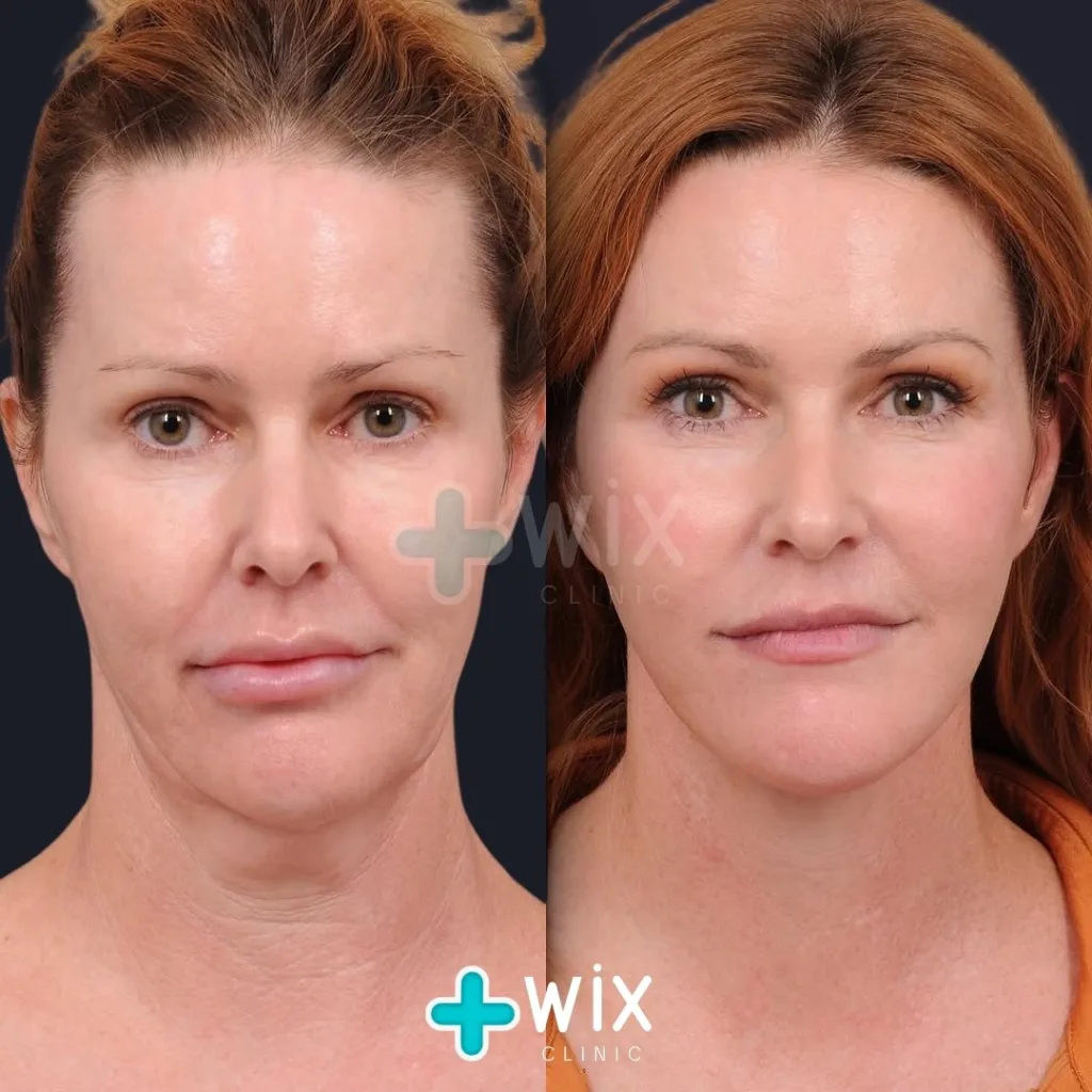 Facelift before and after