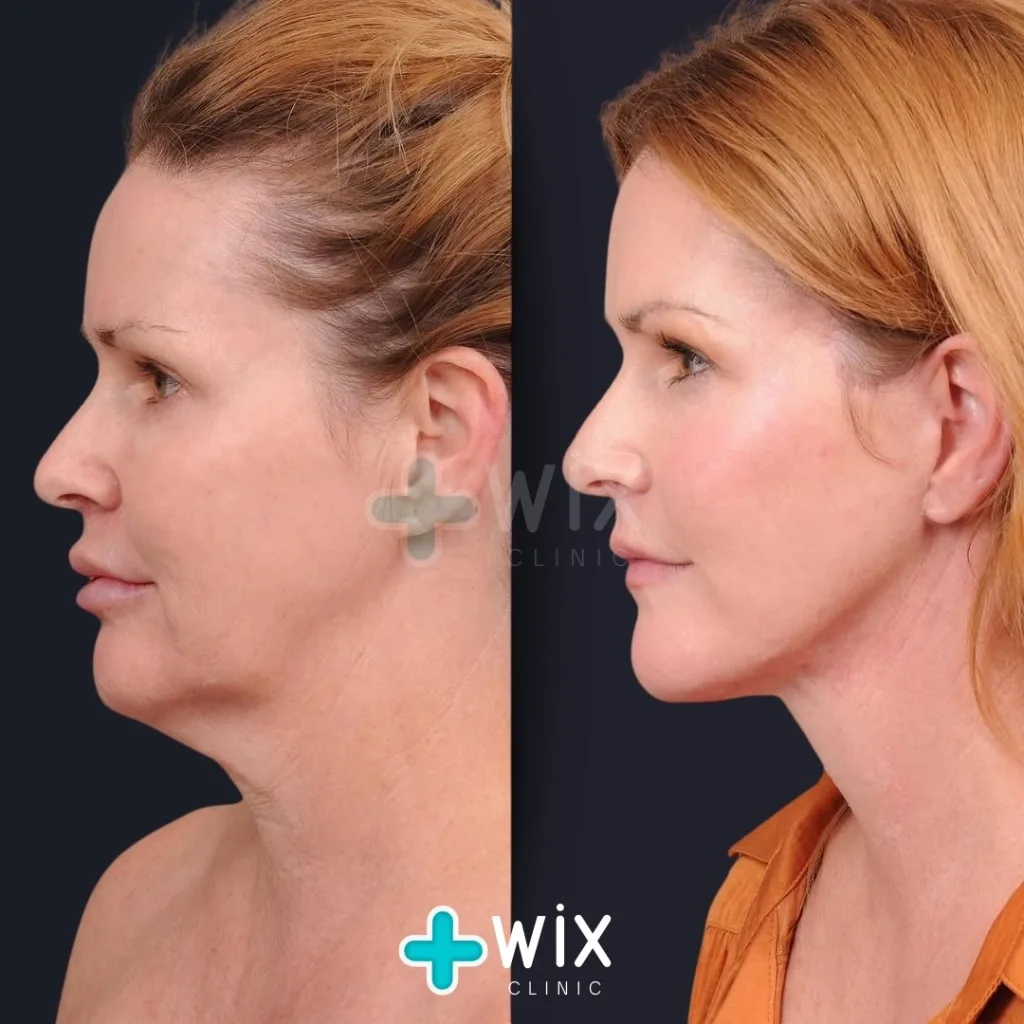 Facelift before and after