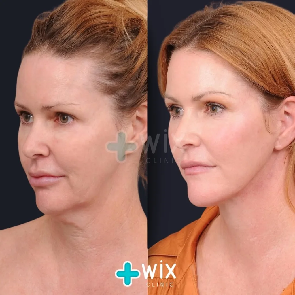 Facelift before and after