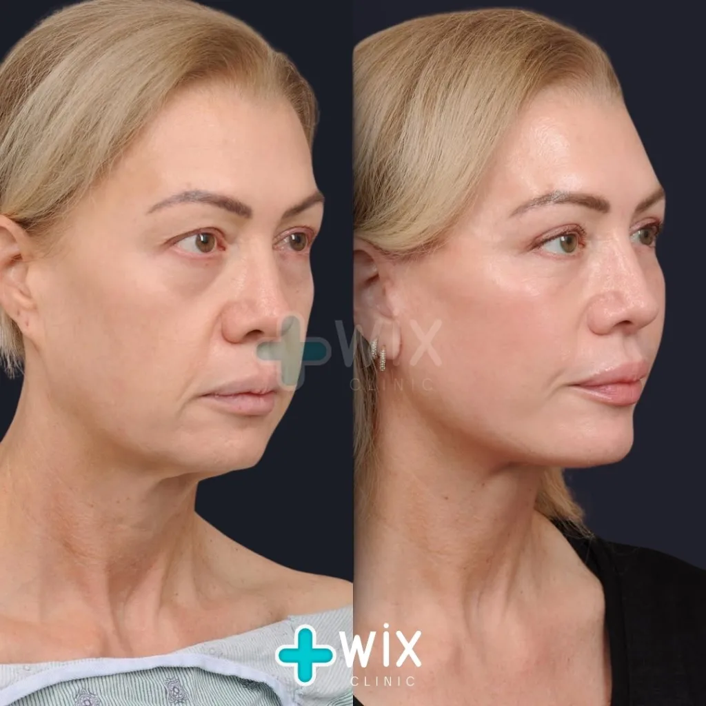 Facelift before and after