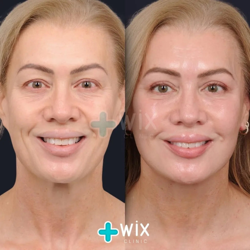 Facelift before and after