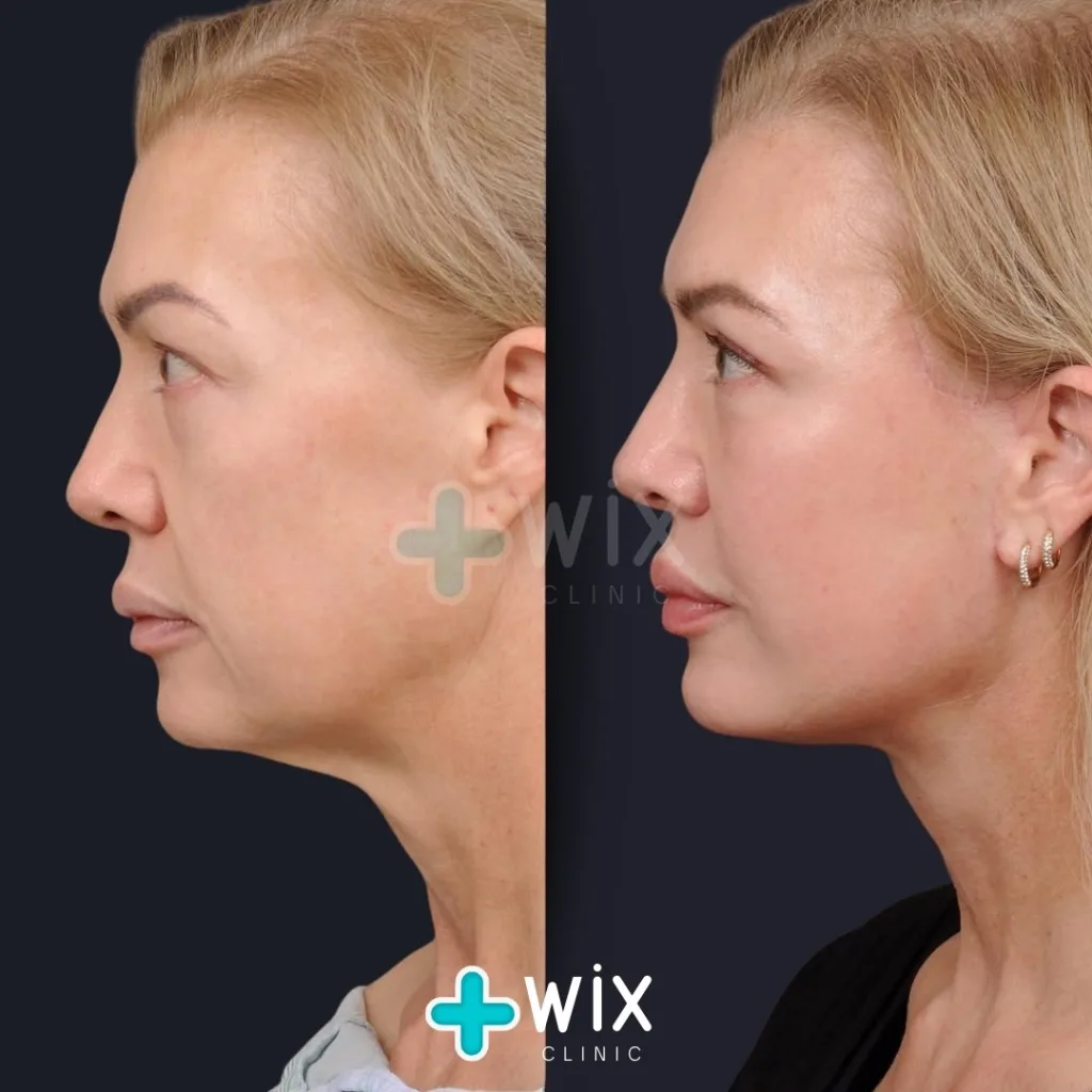 Facelift before and after