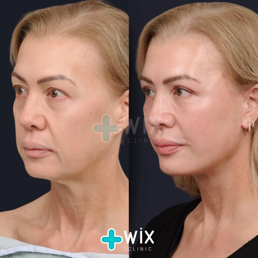 Facelift before and after