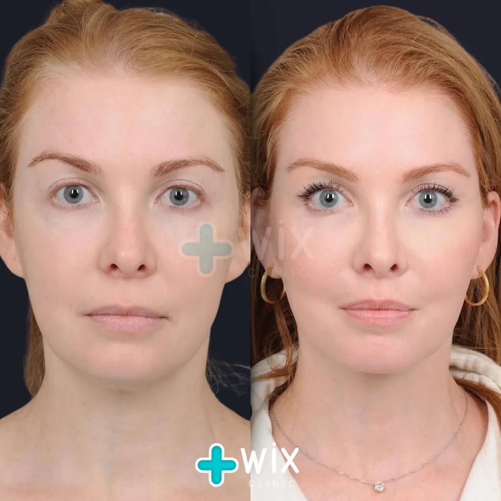 Facelift before and after